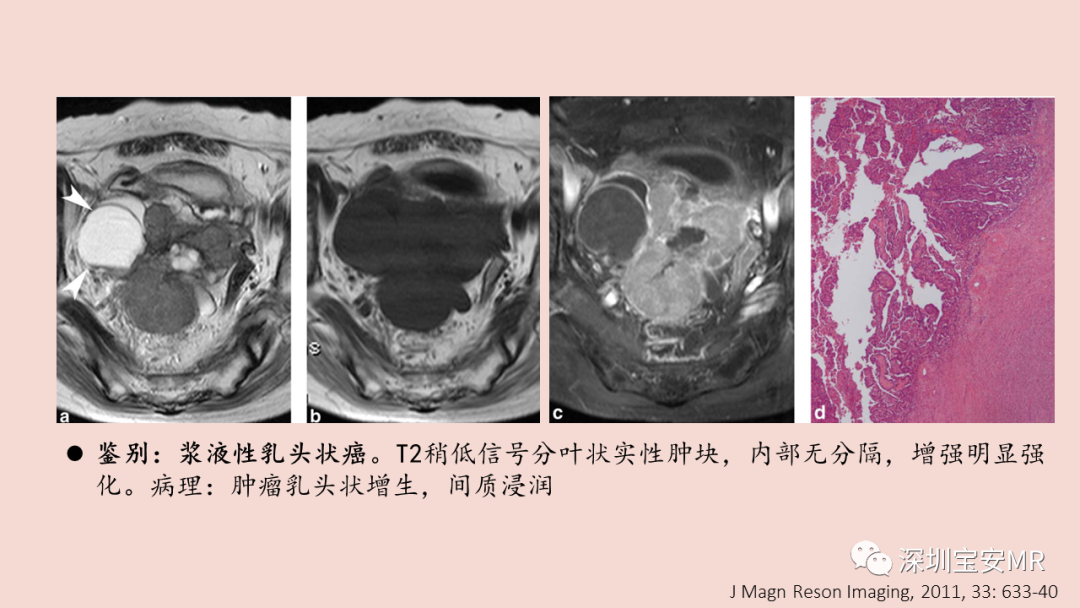 影像PPT - 【PPT】卵巢交界性上皮性肿瘤MRI与病理对照-24