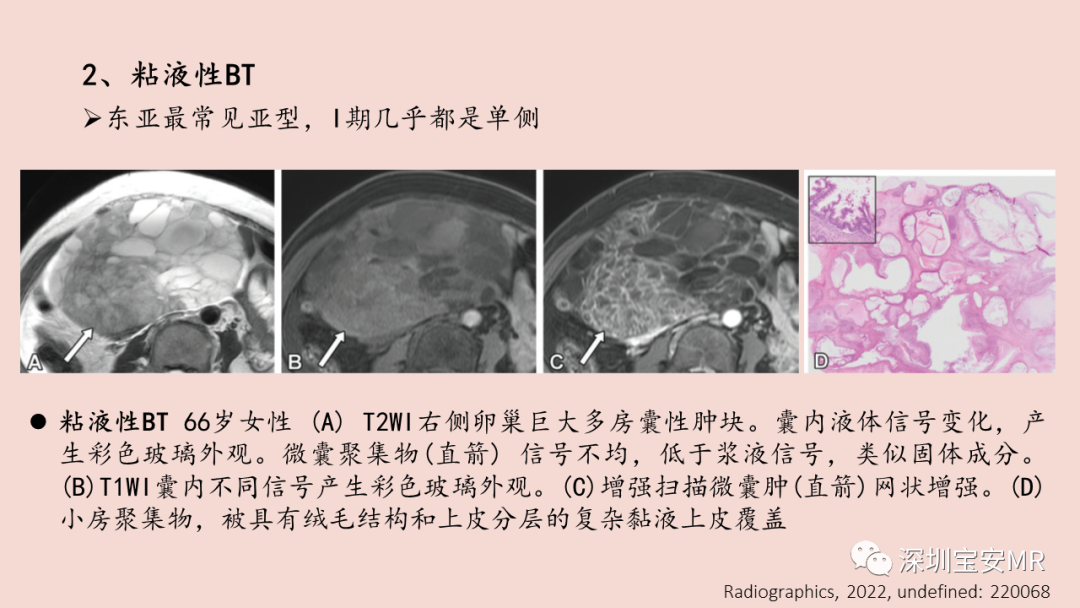 影像PPT - 【PPT】卵巢交界性上皮性肿瘤MRI与病理对照-25