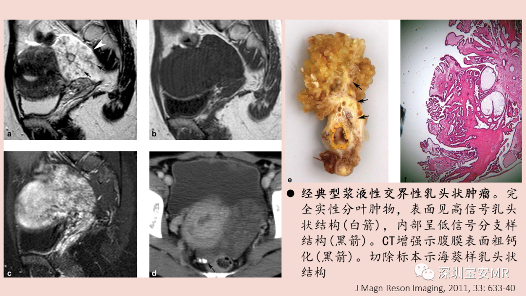 影像PPT - 【PPT】卵巢交界性上皮性肿瘤MRI与病理对照-22