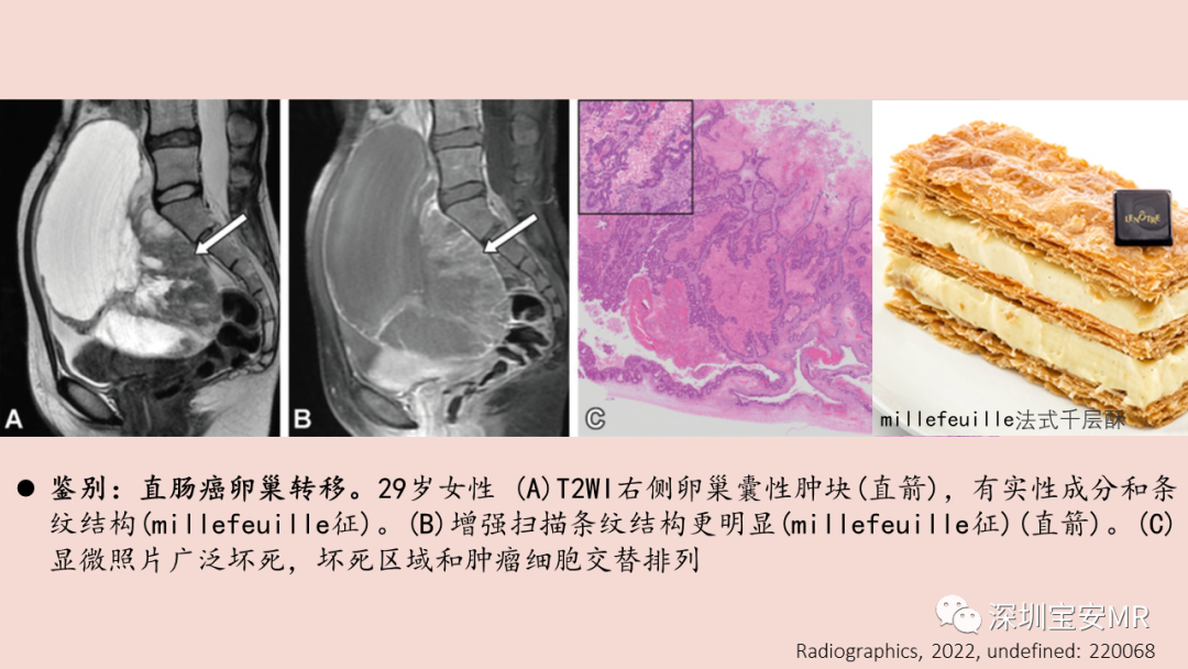 影像PPT - 【PPT】卵巢交界性上皮性肿瘤MRI与病理对照-30