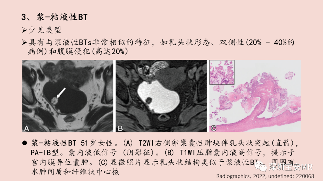 影像PPT - 【PPT】卵巢交界性上皮性肿瘤MRI与病理对照-32
