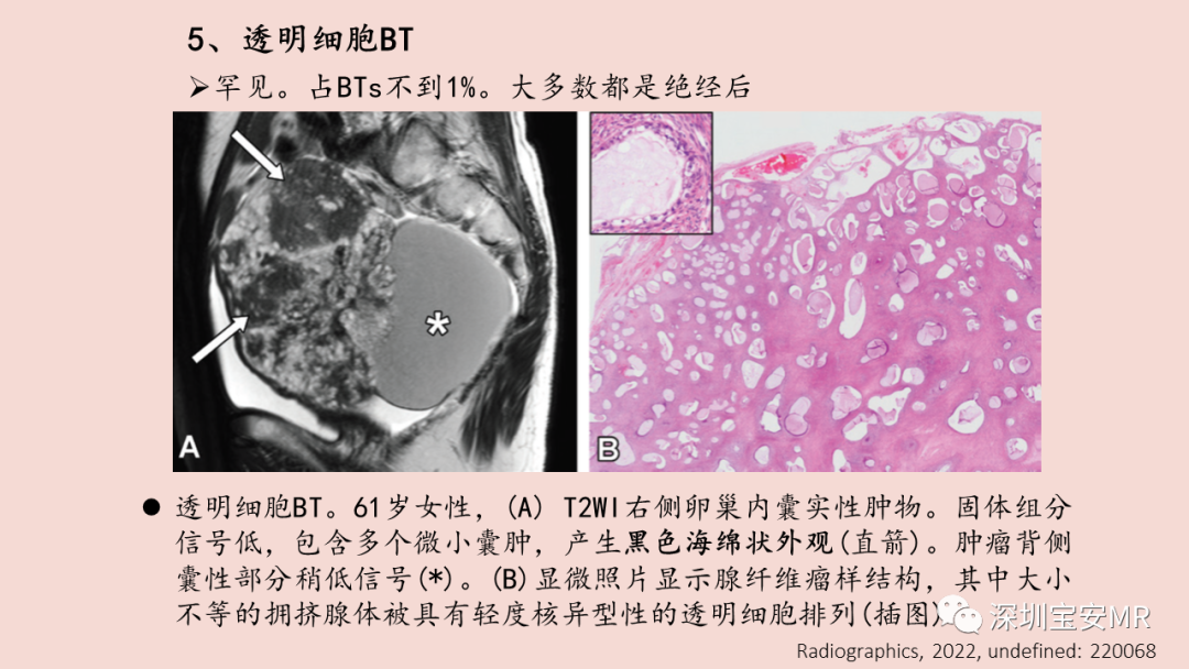 影像PPT - 【PPT】卵巢交界性上皮性肿瘤MRI与病理对照-36