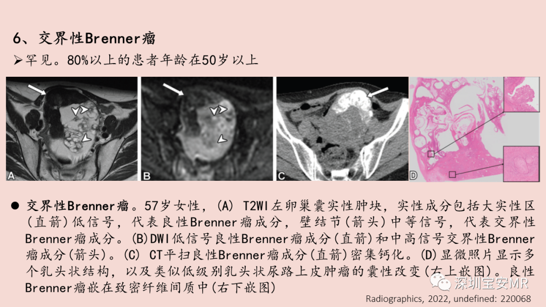 影像PPT - 【PPT】卵巢交界性上皮性肿瘤MRI与病理对照-37