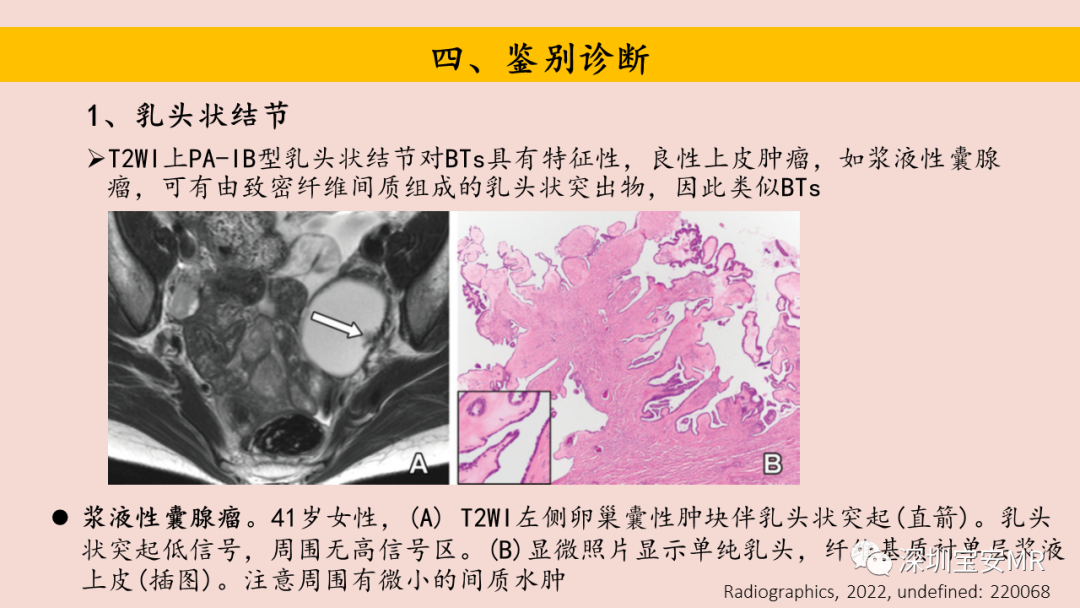 影像PPT - 【PPT】卵巢交界性上皮性肿瘤MRI与病理对照-39
