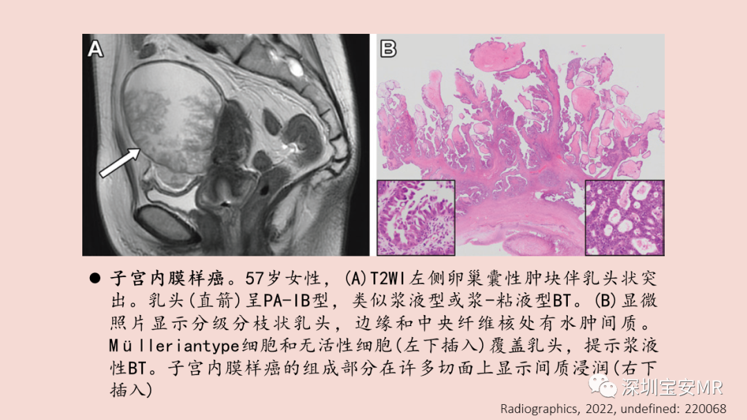 影像PPT - 【PPT】卵巢交界性上皮性肿瘤MRI与病理对照-40