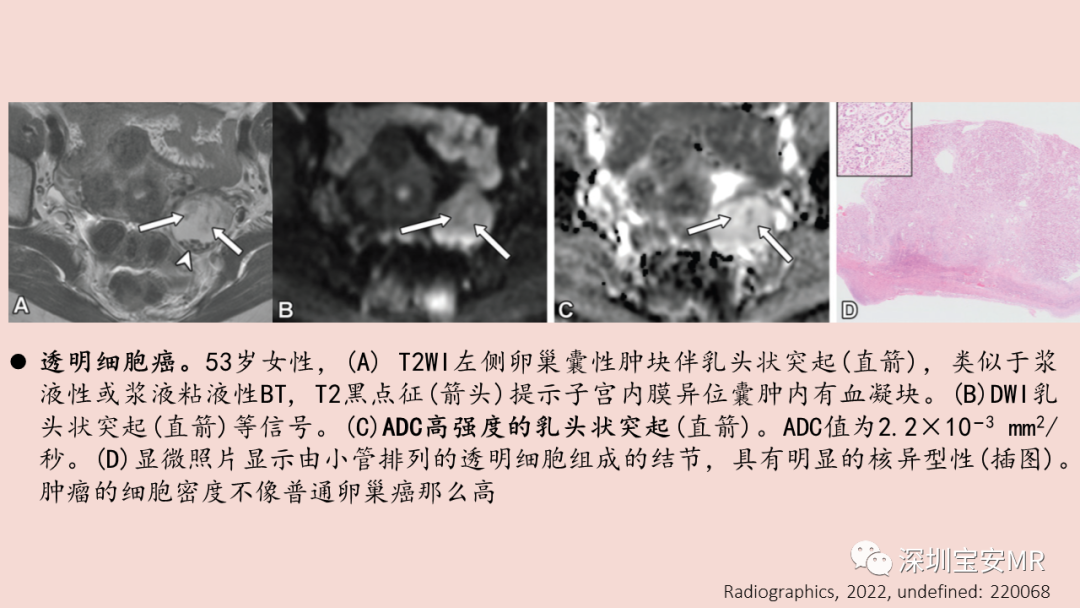 影像PPT - 【PPT】卵巢交界性上皮性肿瘤MRI与病理对照-41