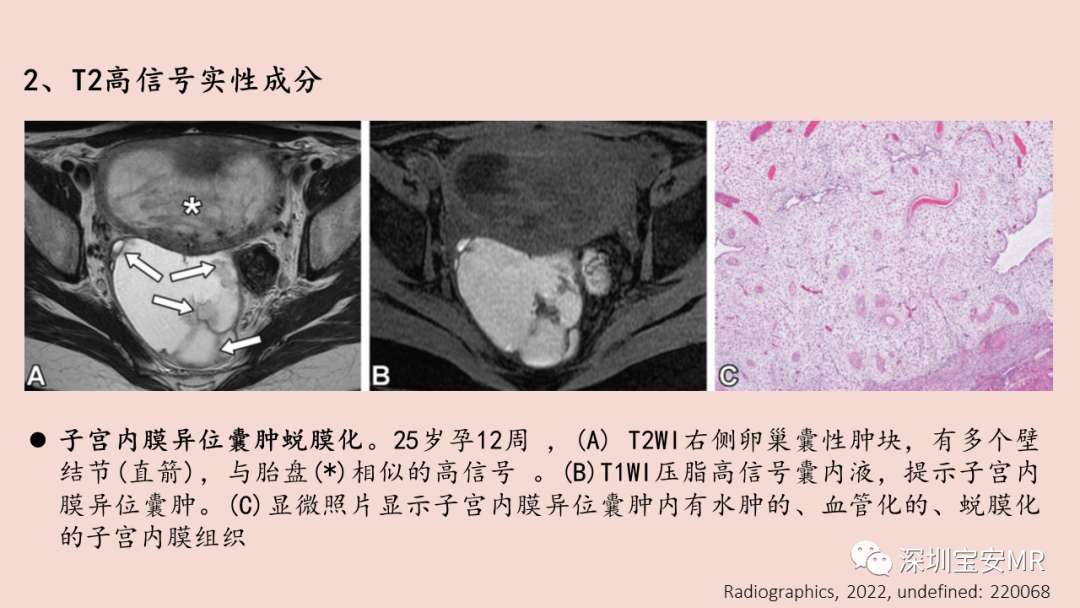 影像PPT - 【PPT】卵巢交界性上皮性肿瘤MRI与病理对照-42