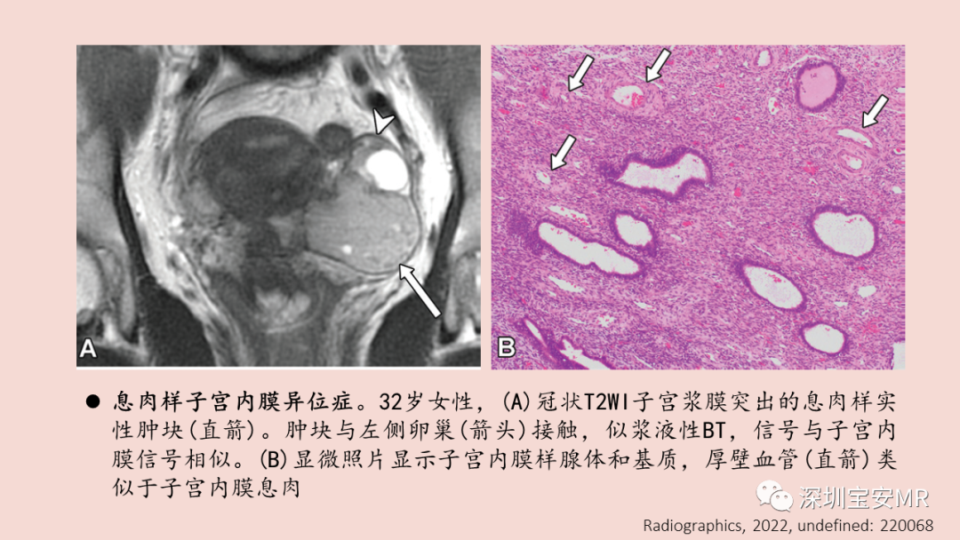 影像PPT - 【PPT】卵巢交界性上皮性肿瘤MRI与病理对照-43