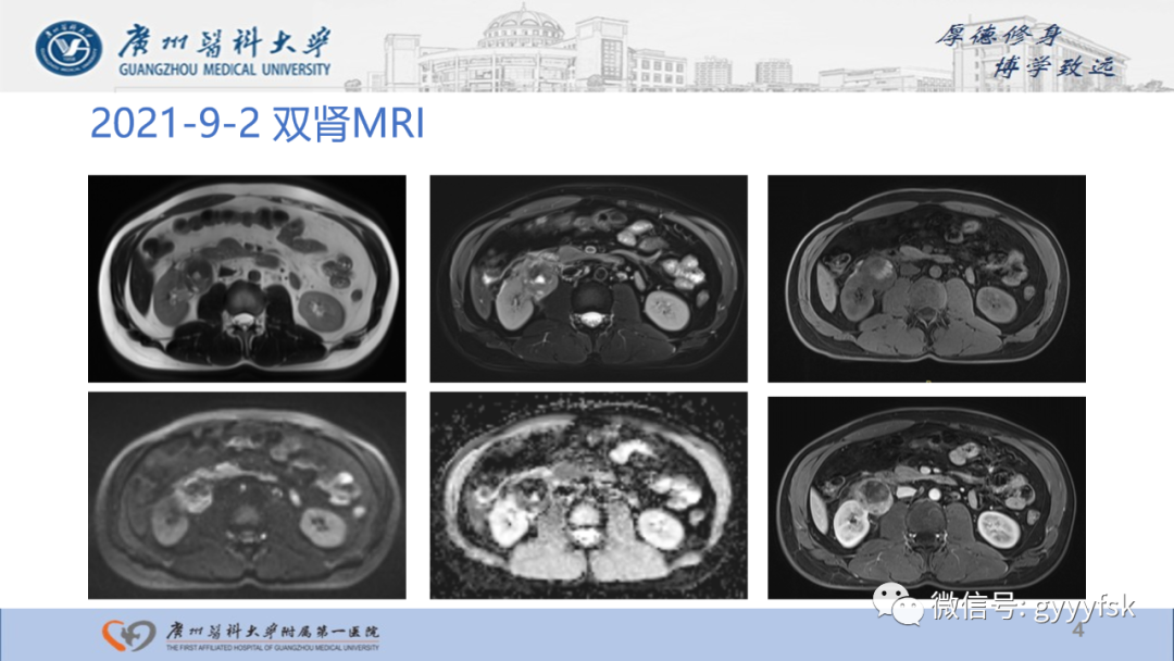 影像PPT - 【PPT】肾少见肿瘤影像诊断的文献汇报-4