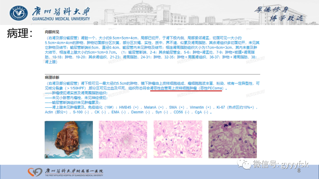 影像PPT - 【PPT】肾少见肿瘤影像诊断的文献汇报-8