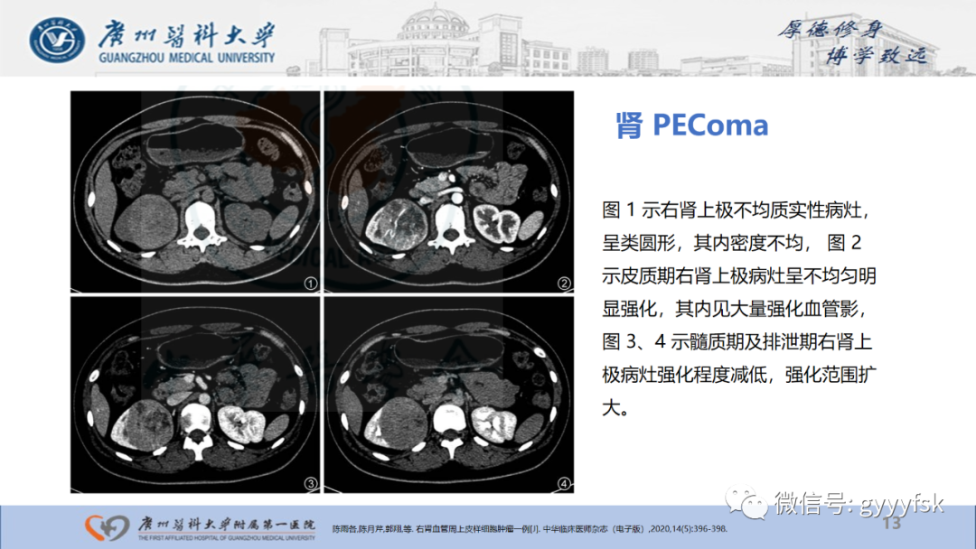 影像PPT - 【PPT】肾少见肿瘤影像诊断的文献汇报-13