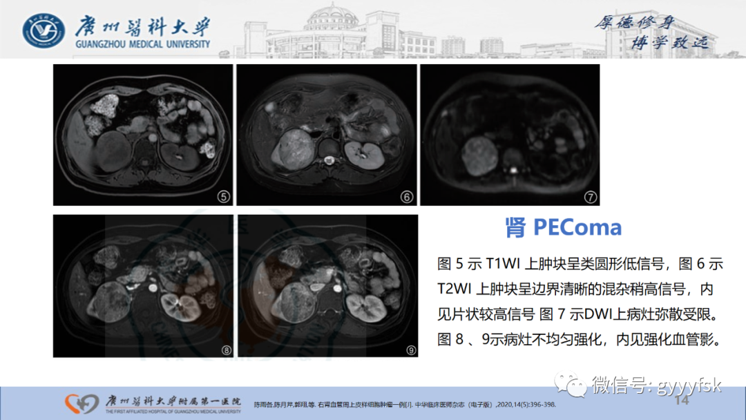 影像PPT - 【PPT】肾少见肿瘤影像诊断的文献汇报-14