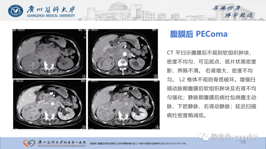影像PPT - 【PPT】肾少见肿瘤影像诊断的文献汇报-15