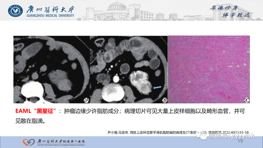 影像PPT - 【PPT】肾少见肿瘤影像诊断的文献汇报-19