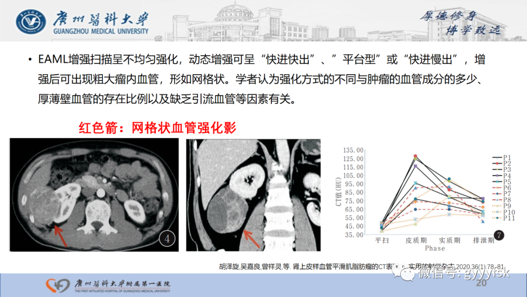 影像PPT - 【PPT】肾少见肿瘤影像诊断的文献汇报-20