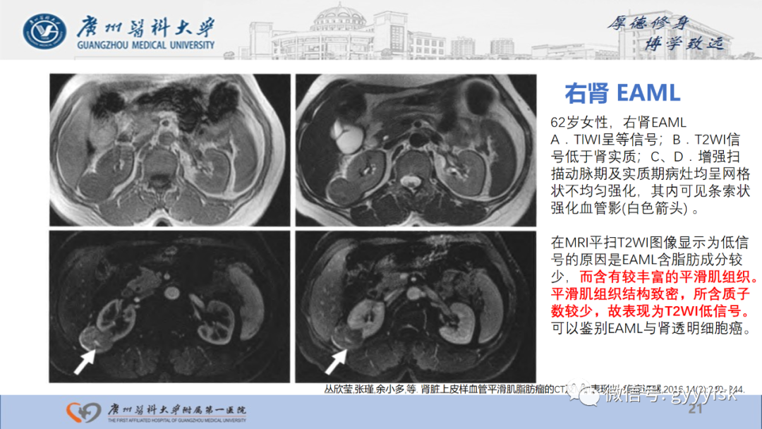影像PPT - 【PPT】肾少见肿瘤影像诊断的文献汇报-21