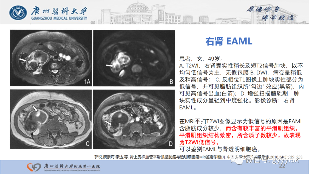 影像PPT - 【PPT】肾少见肿瘤影像诊断的文献汇报-22