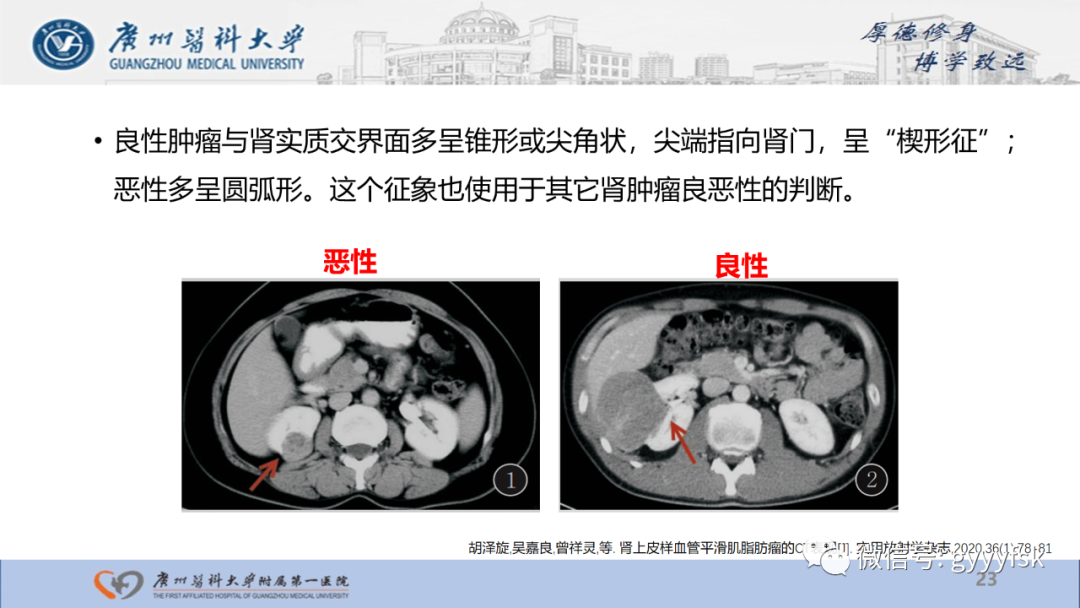 影像PPT - 【PPT】肾少见肿瘤影像诊断的文献汇报-23