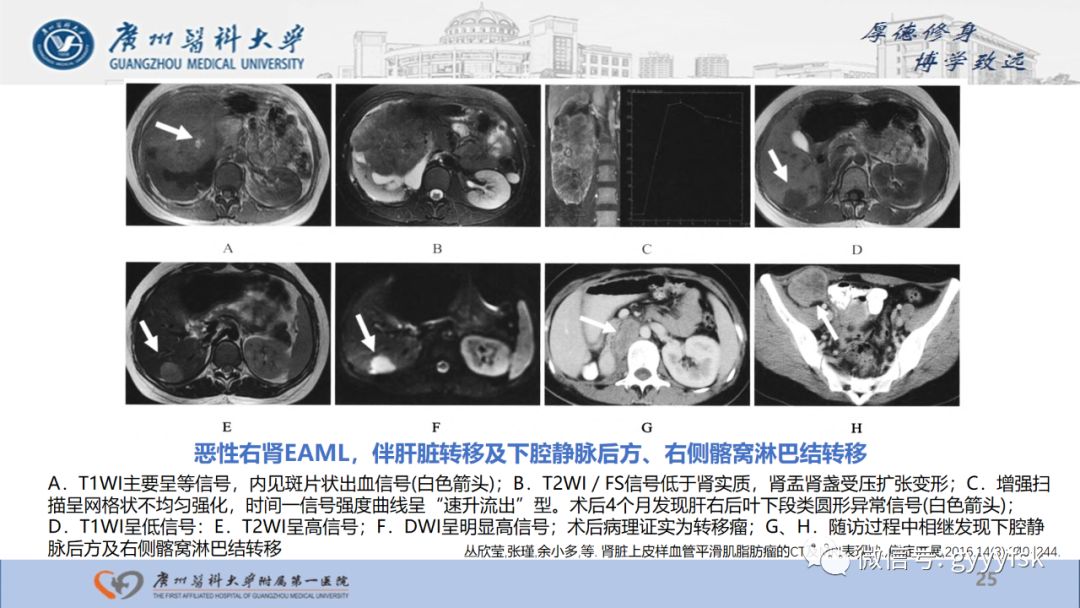 影像PPT - 【PPT】肾少见肿瘤影像诊断的文献汇报-25