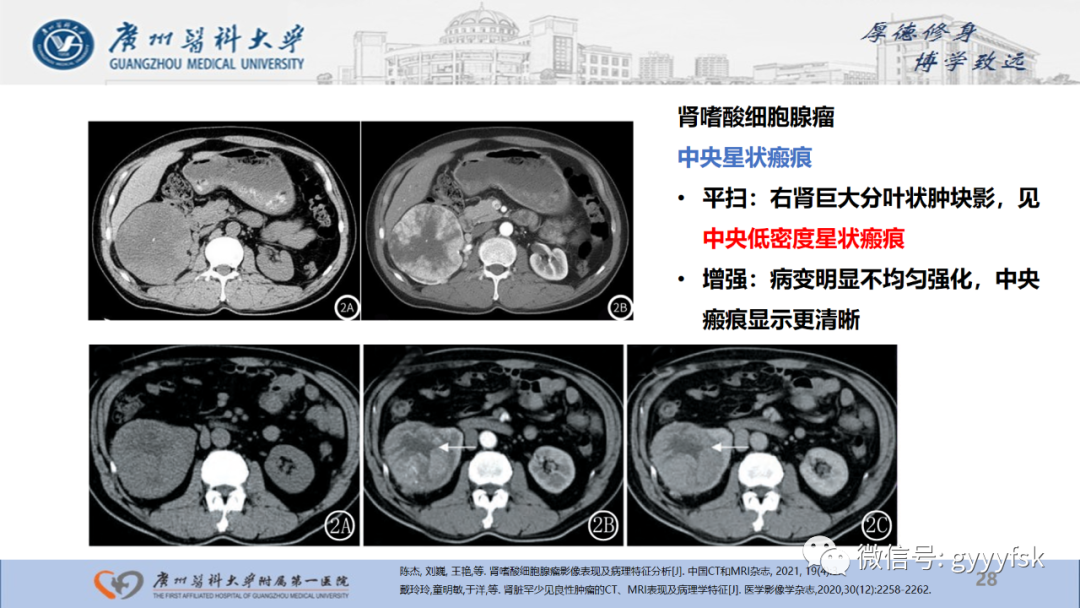 影像PPT - 【PPT】肾少见肿瘤影像诊断的文献汇报-28