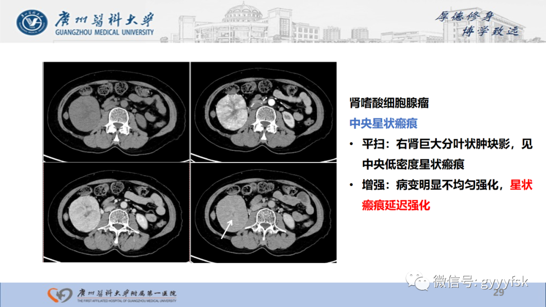 影像PPT - 【PPT】肾少见肿瘤影像诊断的文献汇报-29