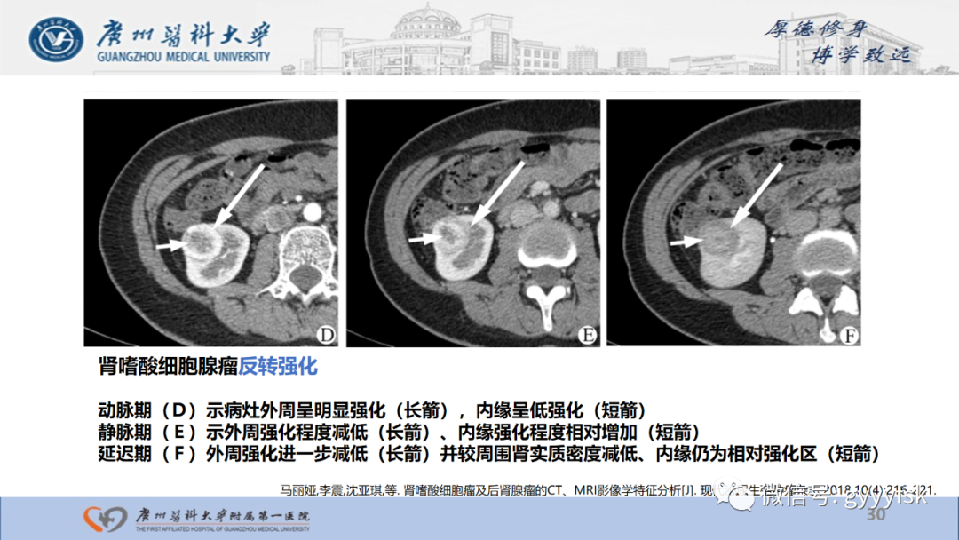 影像PPT - 【PPT】肾少见肿瘤影像诊断的文献汇报-30