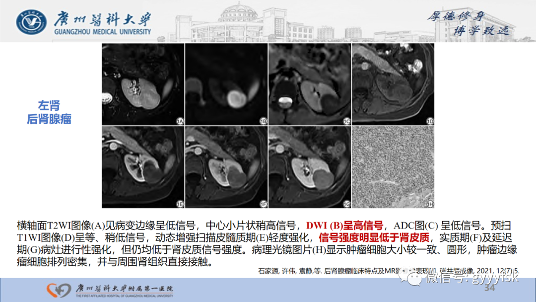 影像PPT - 【PPT】肾少见肿瘤影像诊断的文献汇报-34