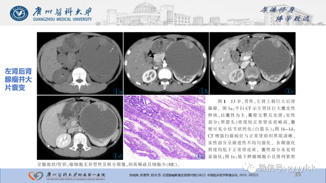 影像PPT - 【PPT】肾少见肿瘤影像诊断的文献汇报-35