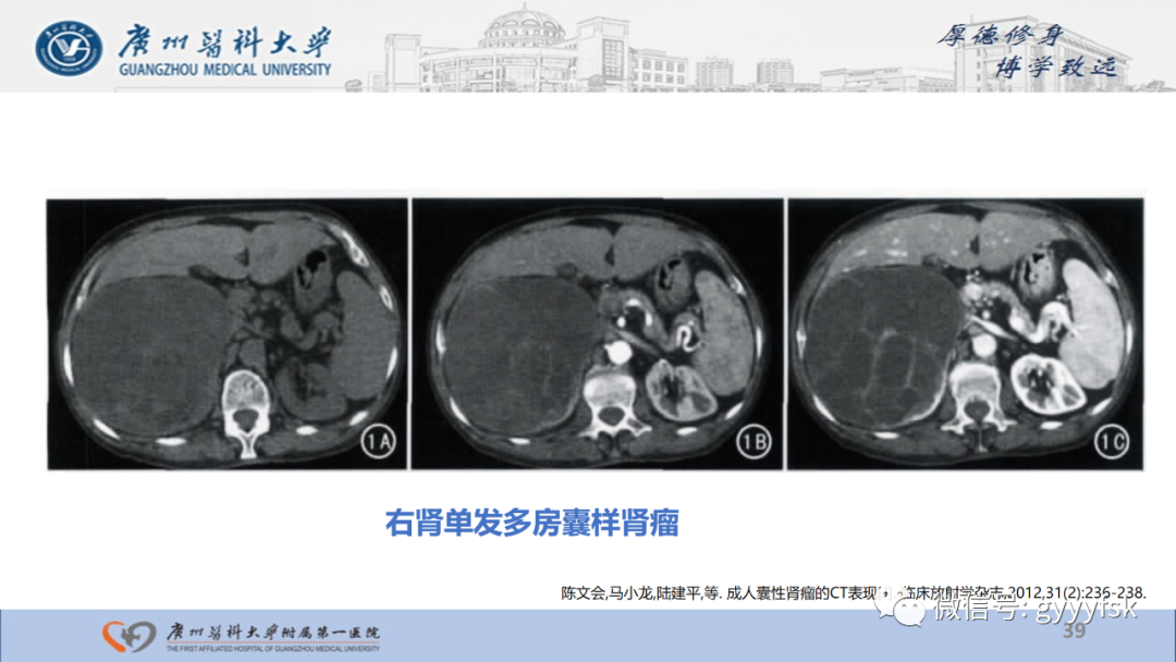 影像PPT - 【PPT】肾少见肿瘤影像诊断的文献汇报-39