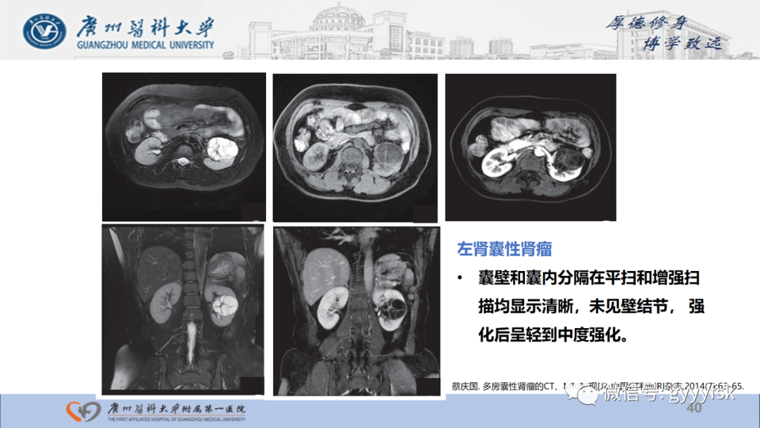 影像PPT - 【PPT】肾少见肿瘤影像诊断的文献汇报-40