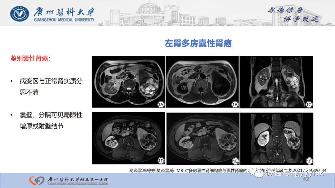 影像PPT - 【PPT】肾少见肿瘤影像诊断的文献汇报-42