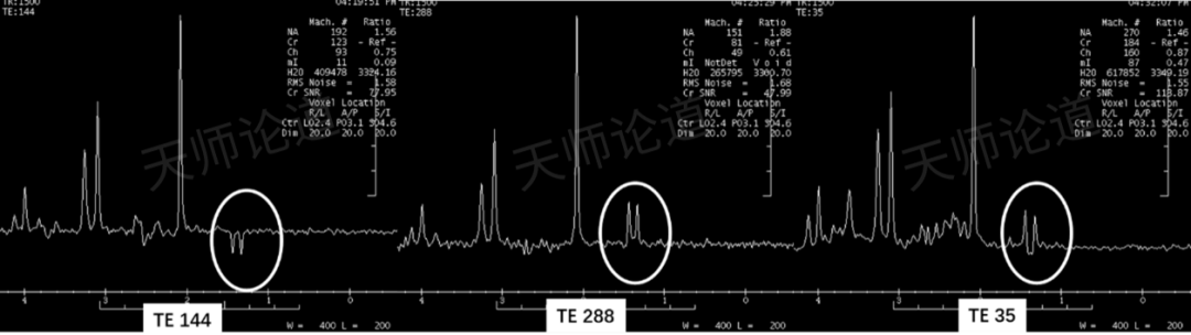 影像PPT - 磁共振波谱成像基本概念与参数解读-7 影像PPT - 磁共振波谱成像基本概念与参数解读-7