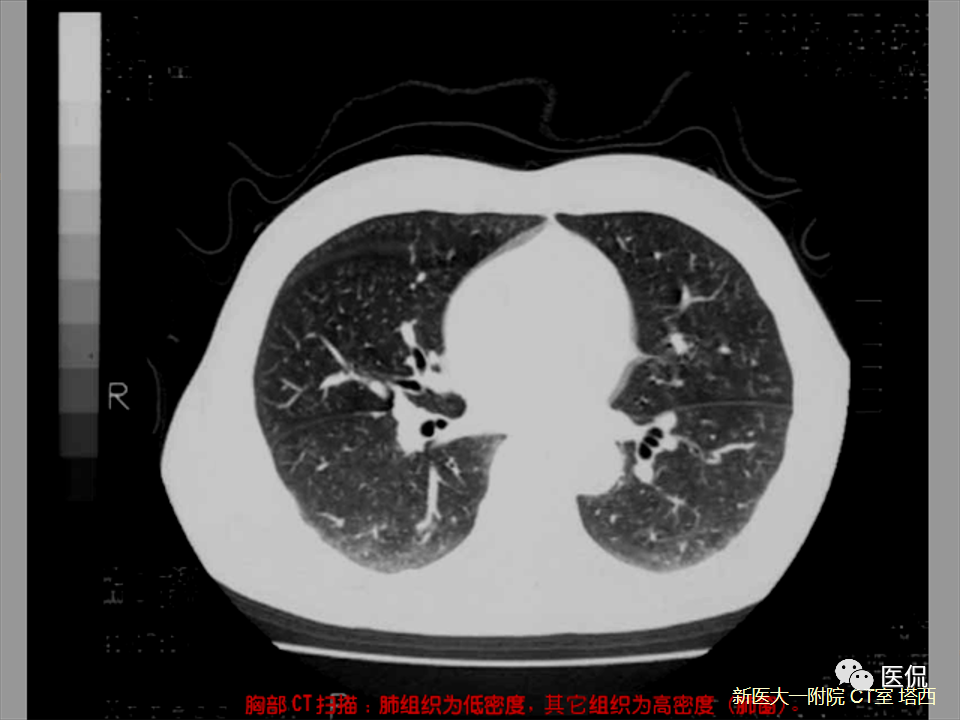 影像PPT - 【PPT】呼吸系统常见疾病影像诊断-3