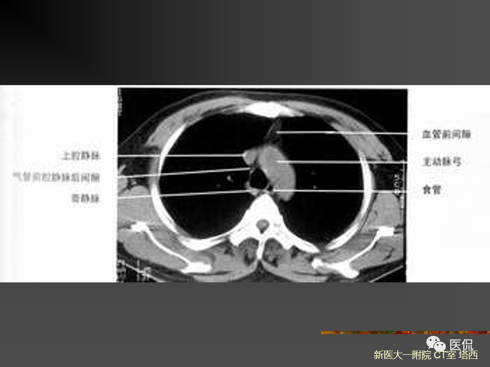 影像PPT - 【PPT】呼吸系统常见疾病影像诊断-5