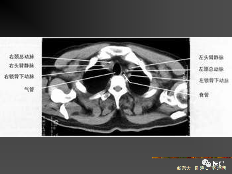 影像PPT - 【PPT】呼吸系统常见疾病影像诊断-8