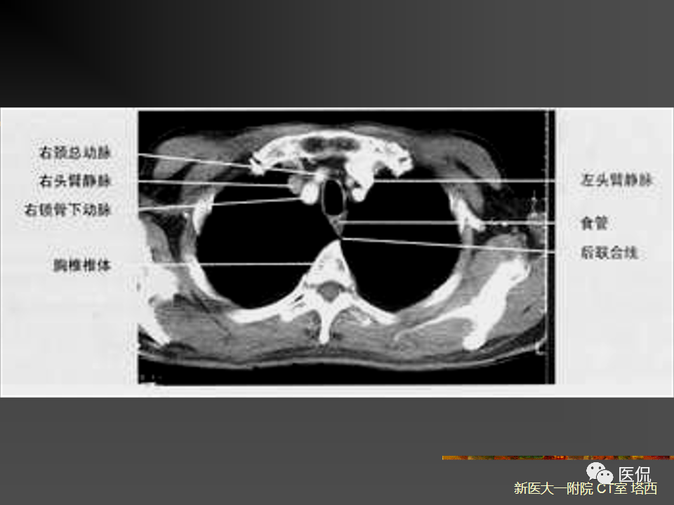影像PPT - 【PPT】呼吸系统常见疾病影像诊断-9