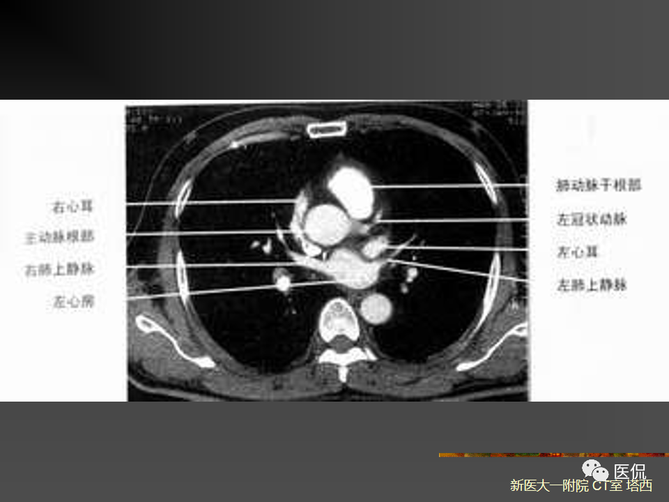 影像PPT - 【PPT】呼吸系统常见疾病影像诊断-14