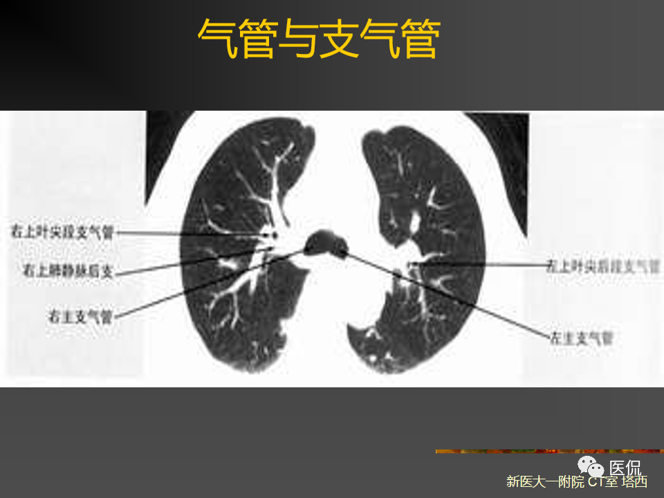 影像PPT - 【PPT】呼吸系统常见疾病影像诊断-16