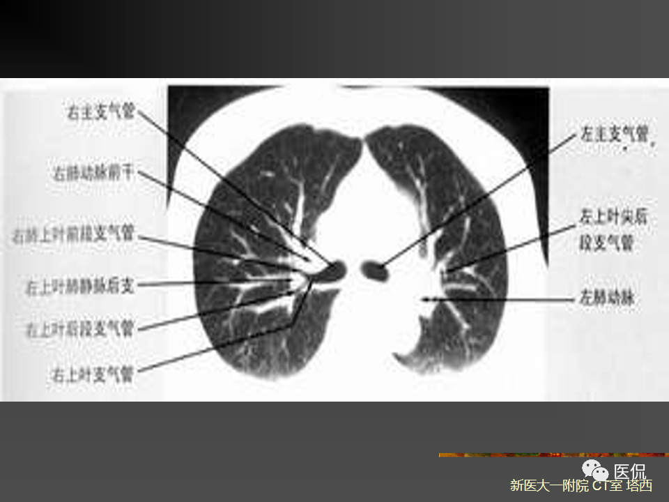 影像PPT - 【PPT】呼吸系统常见疾病影像诊断-17
