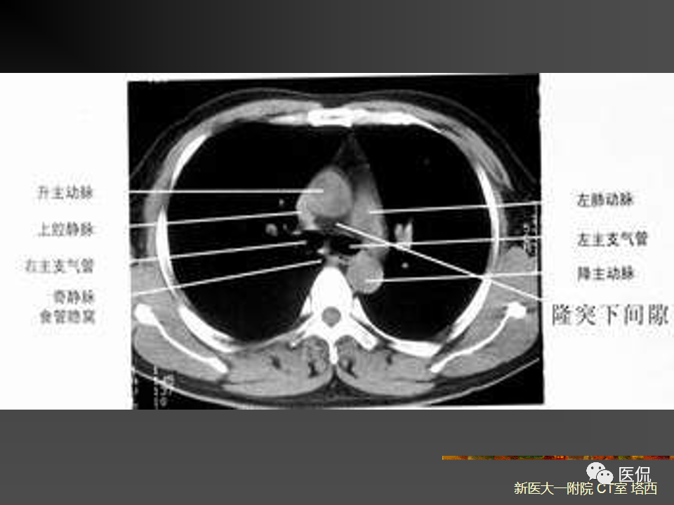 影像PPT - 【PPT】呼吸系统常见疾病影像诊断-18