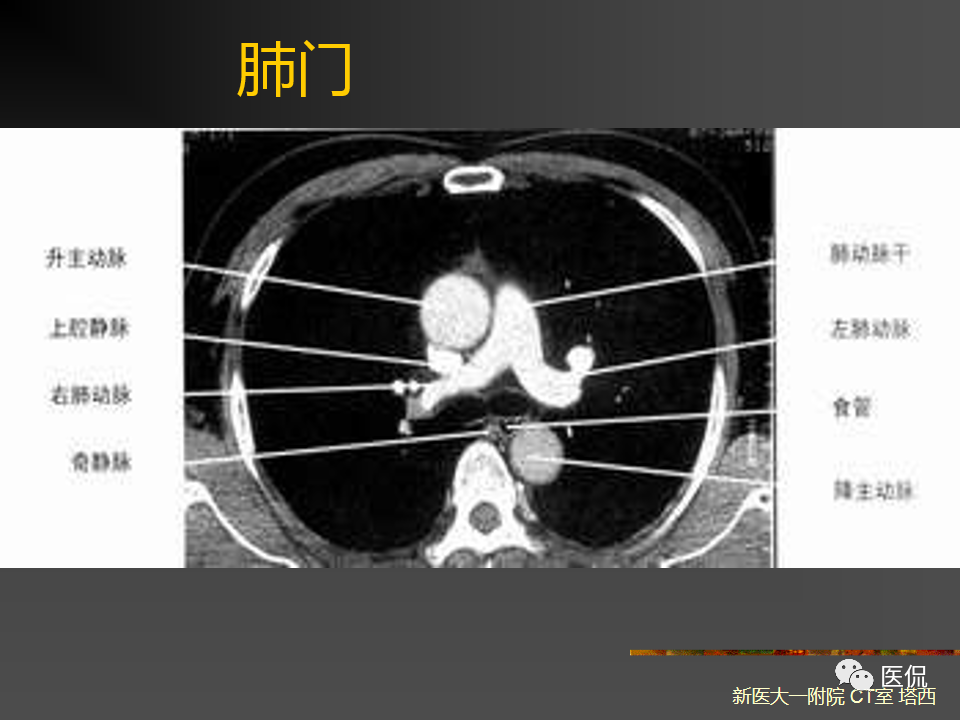 影像PPT - 【PPT】呼吸系统常见疾病影像诊断-20