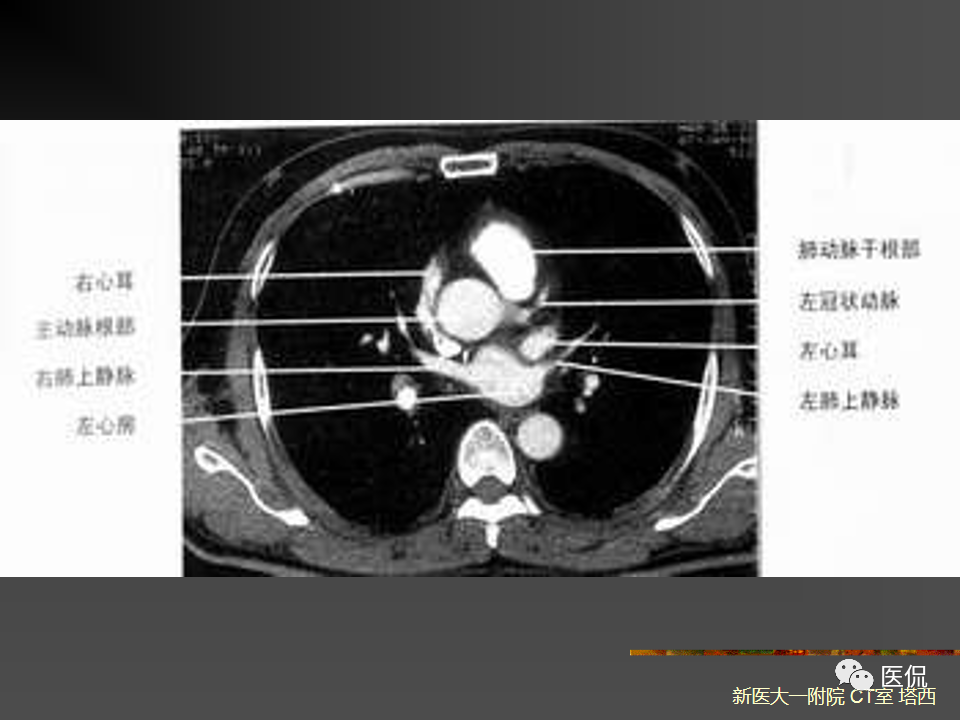 影像PPT - 【PPT】呼吸系统常见疾病影像诊断-19
