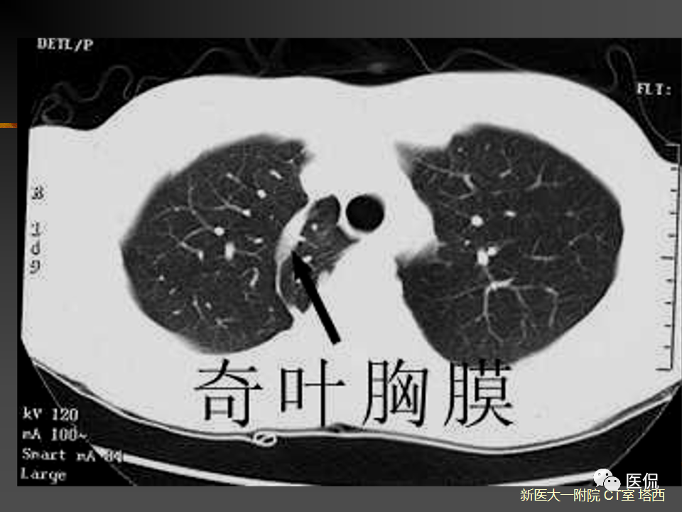 影像PPT - 【PPT】呼吸系统常见疾病影像诊断-21