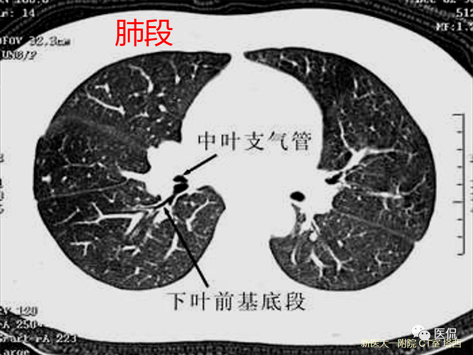 影像PPT - 【PPT】呼吸系统常见疾病影像诊断-22