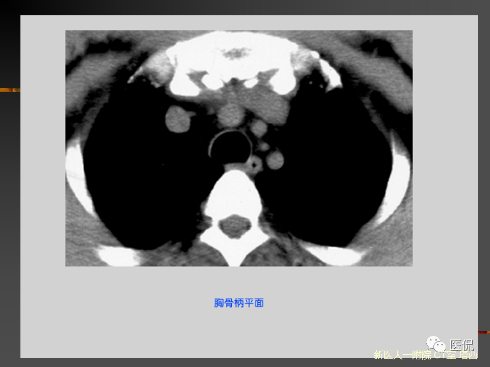 影像PPT - 【PPT】呼吸系统常见疾病影像诊断-24