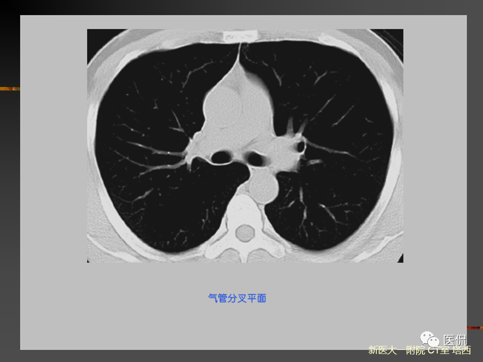 影像PPT - 【PPT】呼吸系统常见疾病影像诊断-29