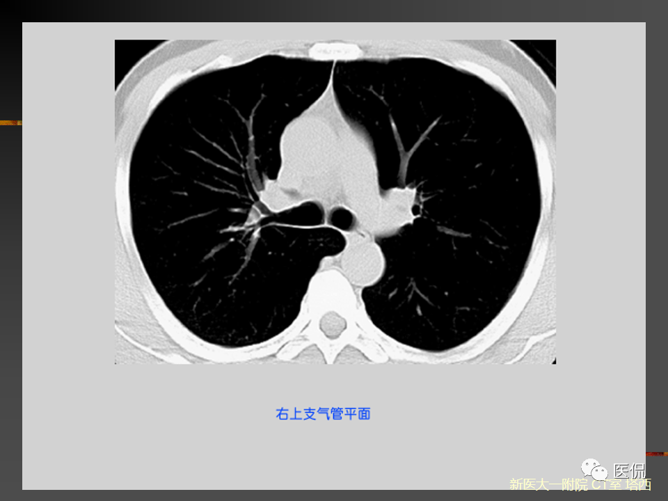 影像PPT - 【PPT】呼吸系统常见疾病影像诊断-30