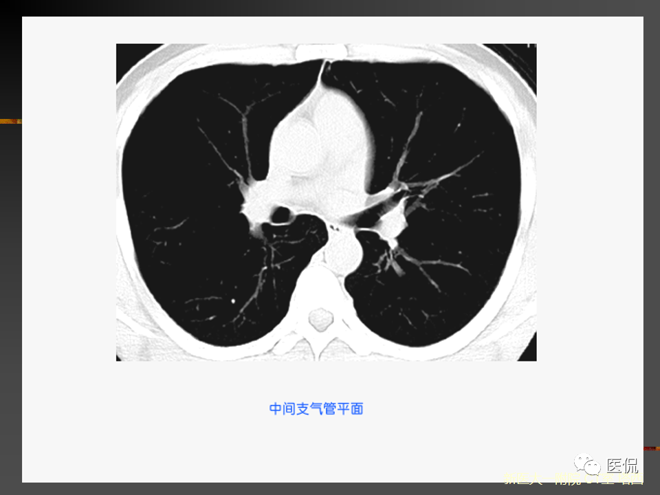 影像PPT - 【PPT】呼吸系统常见疾病影像诊断-31
