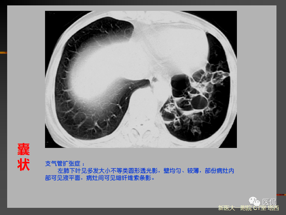 影像PPT - 【PPT】呼吸系统常见疾病影像诊断-37