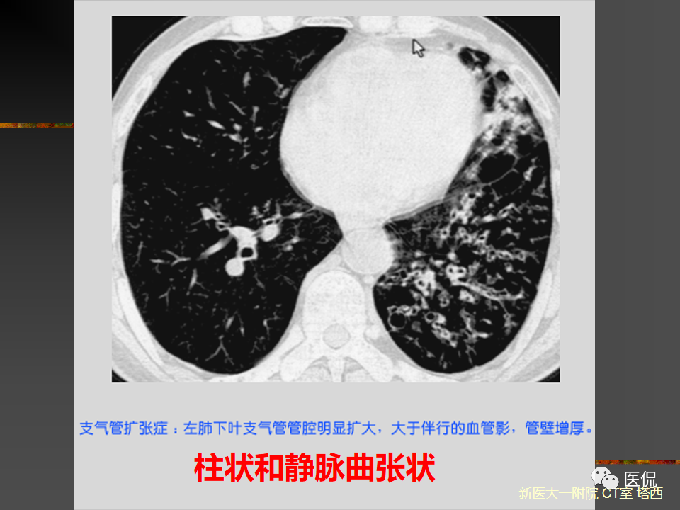 影像PPT - 【PPT】呼吸系统常见疾病影像诊断-38